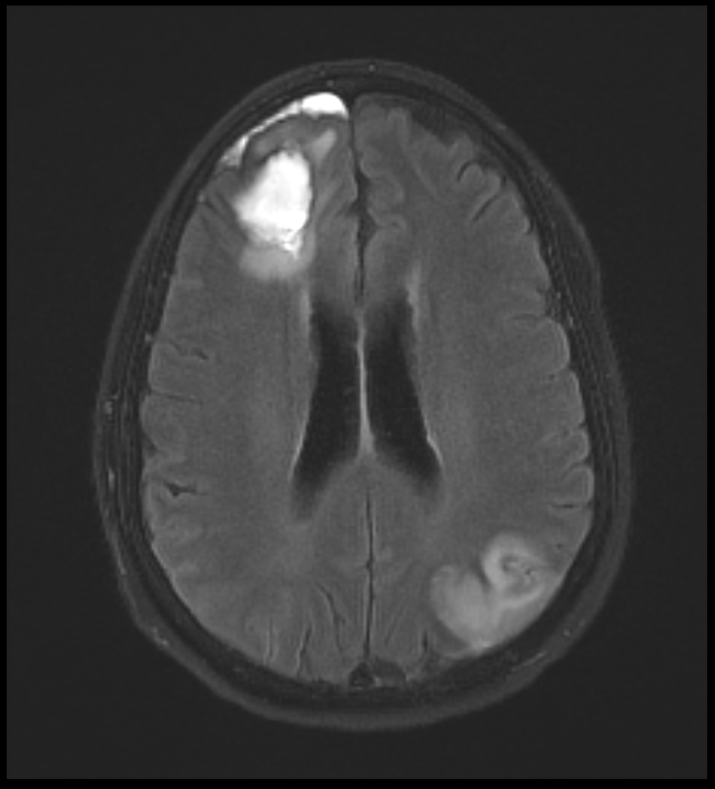 cns vasculitis icd 10 code