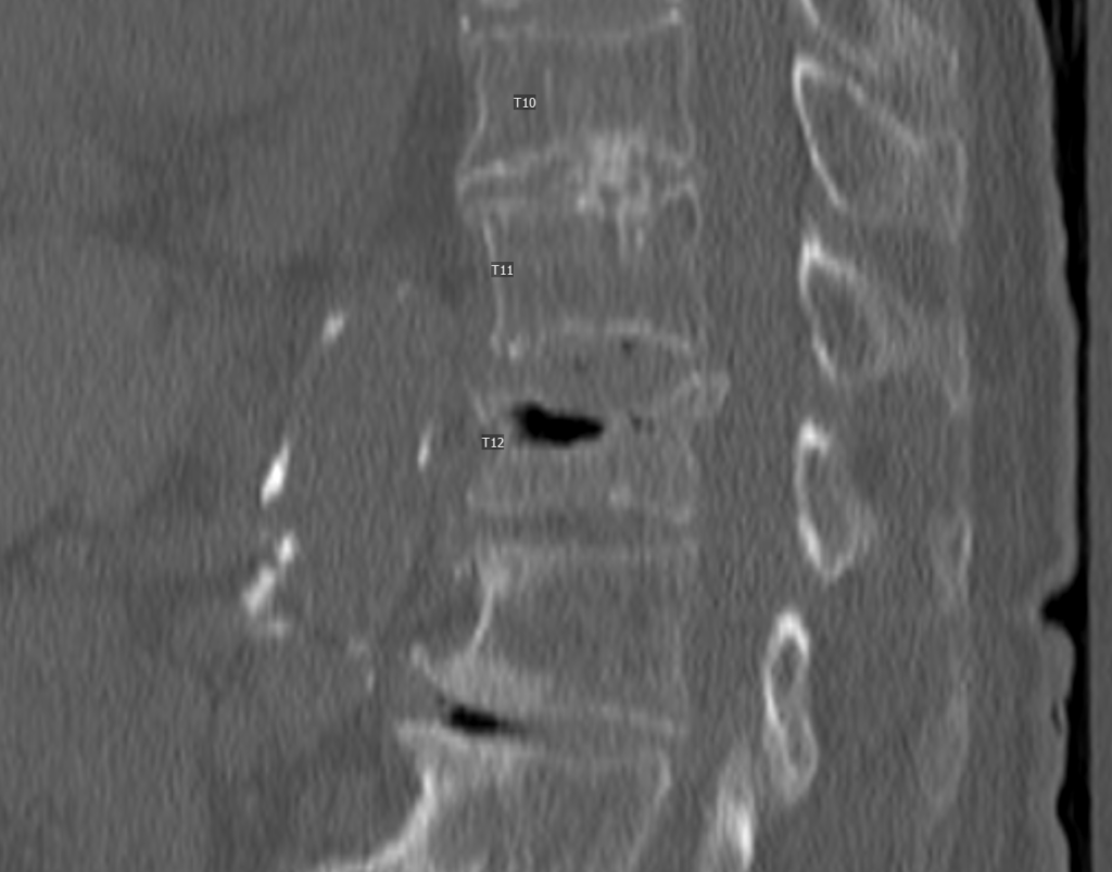 T12 Vertebroplasty - Neurointerventional Atlas